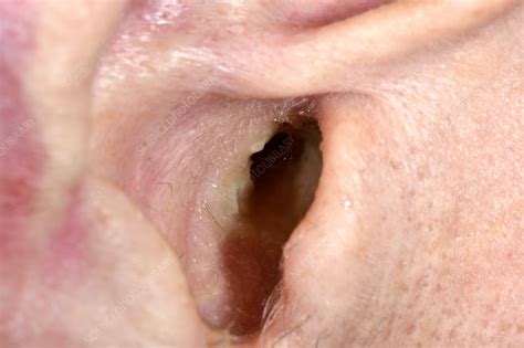 Ear infection - Stock Image - C042/6303 - Science Photo Library