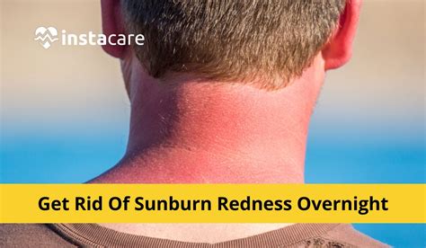 Impressive Info About How To Get Rid Of Redness In Sunburn - Warchild