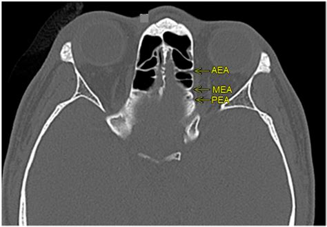 Diagnostics | Free Full-Text | The Effects of Suprabullar Pneumatization on the Orientation of ...