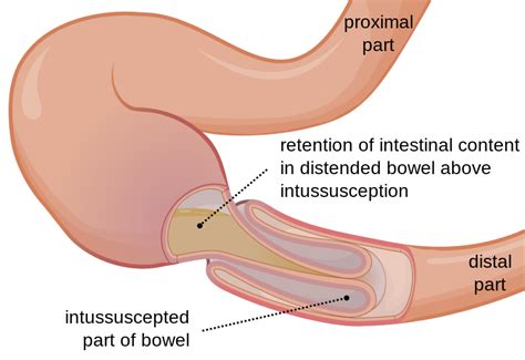 Pathology Reviewer: Intestinal linvagination