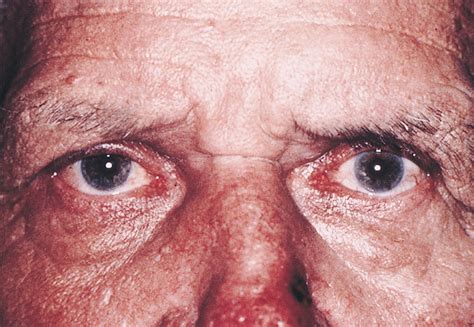 Extramedullary Myeloid Cell Tumor in an Elderly Man | Geriatrics | JAMA Ophthalmology | JAMA Network