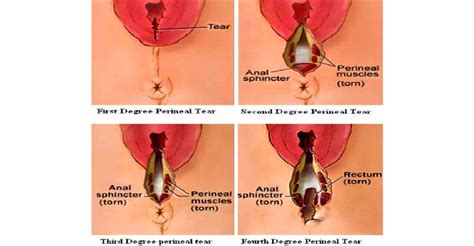 Secondary repair of severe chronic fourth-degree perineal tear due to obstetric trauma|Yashoda ...