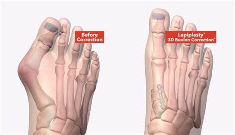 Lapiplasty® 3D Bunion Correction® | Treace Medical Concepts, Inc.