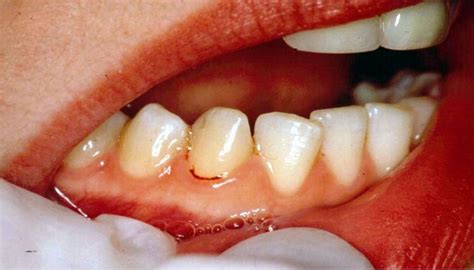 Bleeding gums: Sentinels of non-communicable diseases of ageing