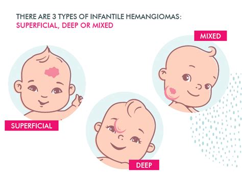 What Is Infantile Hemangioma - Hemangeol