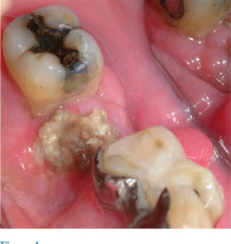 Bisphosphonates Osteonecrosis