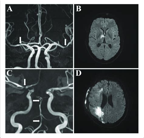 | MR angiography of 2 patients with cerebral vasculitis. MR angiography... | Download Scientific ...