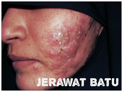 Jerawat Batu | Jerawat, Perawatan kulit, Perawatan kulit alami