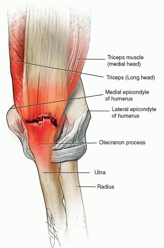 Torn Triceps Tendon – A Rare But Serious Injury | SportsMD