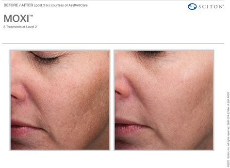 MOXI Laser Treatment - Avie Medspa - Leesburg, VA