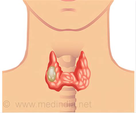 Papillary Thyroid Carcinoma