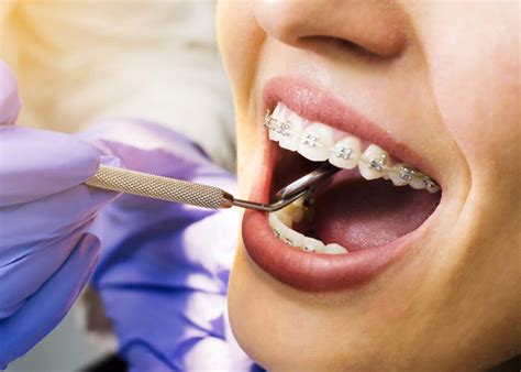 What Are The Benefits of Orthodontic Care? - Escouts