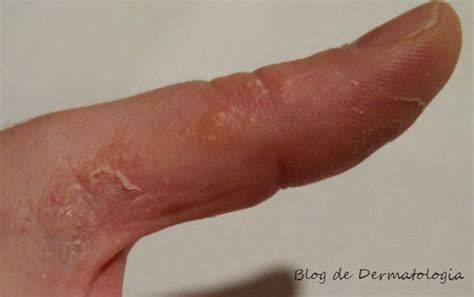 eczema dishidrotico 5 - Dra. LOREA BAGAZGOITIA