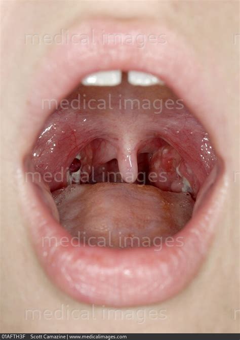 STOCK IMAGE, close-up of the throat showing an infection with exudative ...