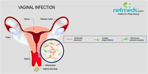 Vaginitis: Causes, Symptoms And Treatment