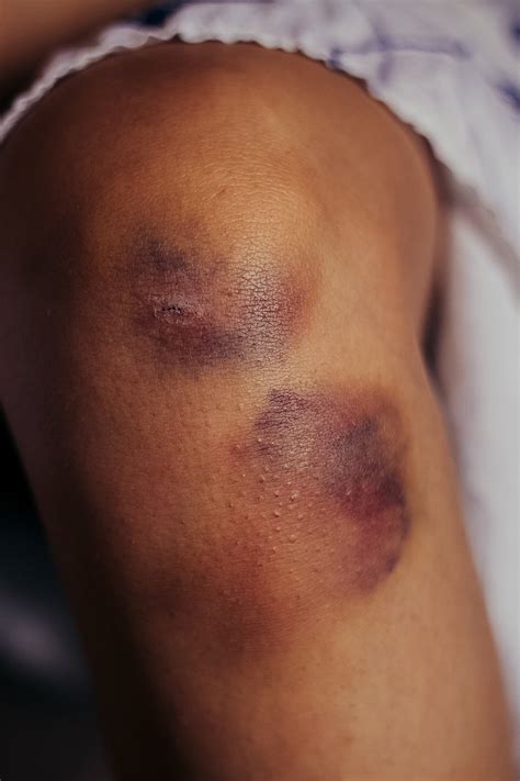 What Do The Colors Of A Bruise Mean Wecare