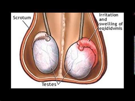 orchitis treatment - YouTube