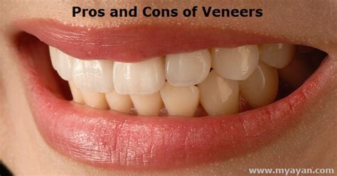 Pros and Cons of Veneers - Bright, Glistening Teeth