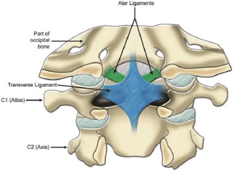 Comorbidity Burden Associated With Poor Outcomes in Atlantoaxial Fusion | OrthoSpineNews