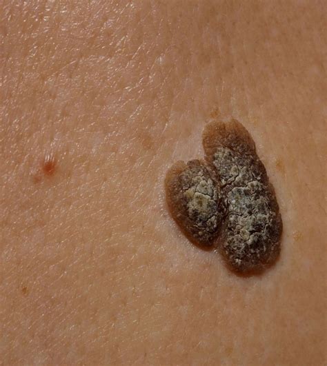 Seborrheic Keratosis Treatments | Sagebrush Dermatology