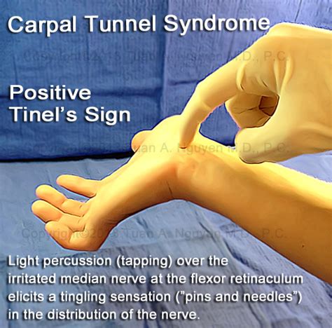 Diagnosis and Testing for Carpal Tunnel Syndrome - Portland Hand Surgery