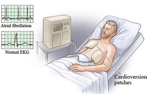 Synchronized Cardioversion | New Health Advisor