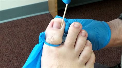 Ingrown Toenail Removal Videos 2022 - An Tâm