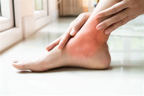 How to Treat Bursitis in Your Feet – Tucson Podiatrist