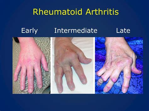 PPT - Rheumatoid Arthritis Update PowerPoint Presentation, free ...