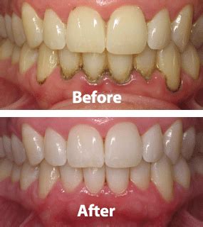 Gingivitis Before And After Treatment