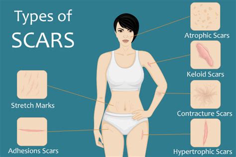 7 Types of Scars: Causes, Symptoms, & Treatment