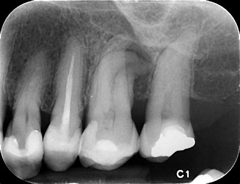 Chronic Apical Periodontitis - Kitsilano Endodontics