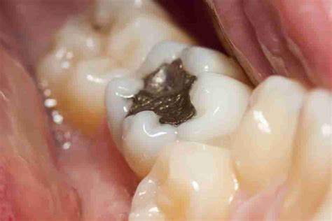 Amalgam fillings - SmilePoint Dental