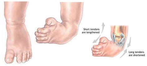 Club Foot - Chicago Foot Care Clinic