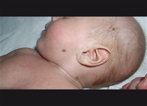 Congenital Rubella Syndrome Blueberry Muffin Rash