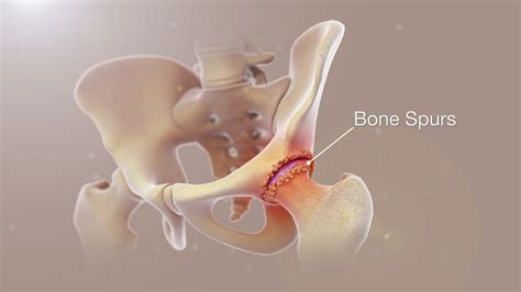 Bone Spurs Shown and Explained Using Medical Animation Still Shot