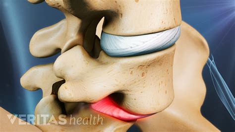 Exercise for Sciatica from Isthmic Spondylolisthesis