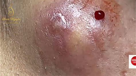 Cystic Acne Extraction This Week, Blackheads Removal - YouTube