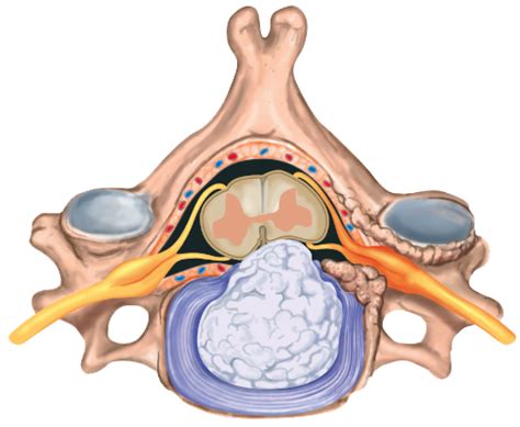 Cervical disc herniation (cervico-brachialgia) - Back center Geneva