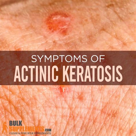 Actinic Keratosis Causes Symptoms Actinic Keratosis Treatment Images