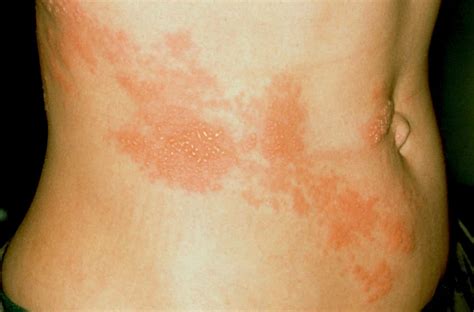 What Is Shingles: Symptoms & Treatment 🩺 Florida Independent
