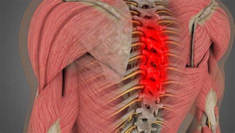 Degenerative Spondylosis Thoracic Spine