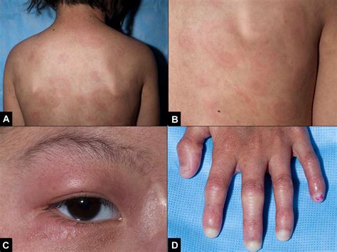 Recurrent fevers, progressive lipodystrophy, and annular plaques in a child - Journal of the ...