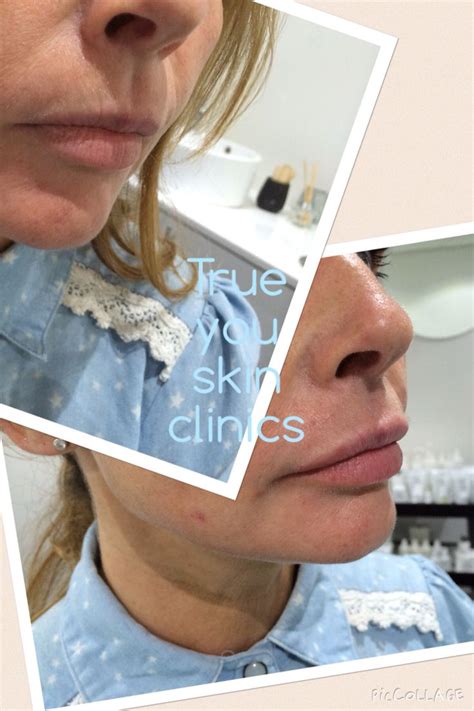 Use dermal fillers to create volume to lips | Dermal fillers, Skin ...