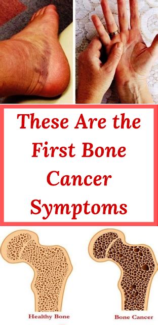 These Are the First Bone Cancer Symptoms - Draco Beauty