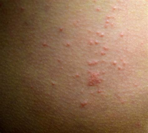 Rashes That Look Like Scabies Causes Symptoms And Tre - vrogue.co