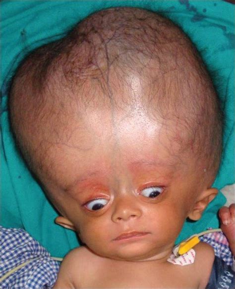 Hydrocephalus In Children