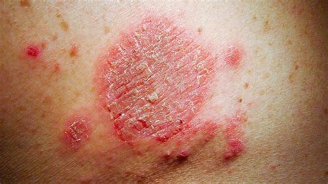 Itchy Spots On Skin Treatment | MedicineNet 2021