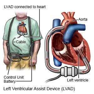 Lvad (Left Ventricular Assist Device) - What You Need to Know