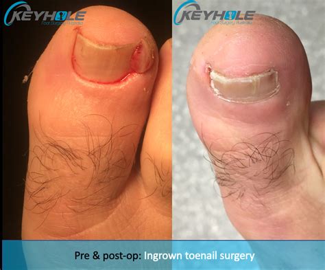 Ingrown Toenail Removal Before And After